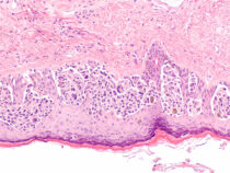Melanoma in situ (MIS) is an early stage, while tumor cells are