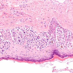 Melanoma in situ (MIS) is an early stage, while tumor cells are